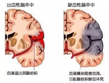 脊髓损伤治疗最新进展概览